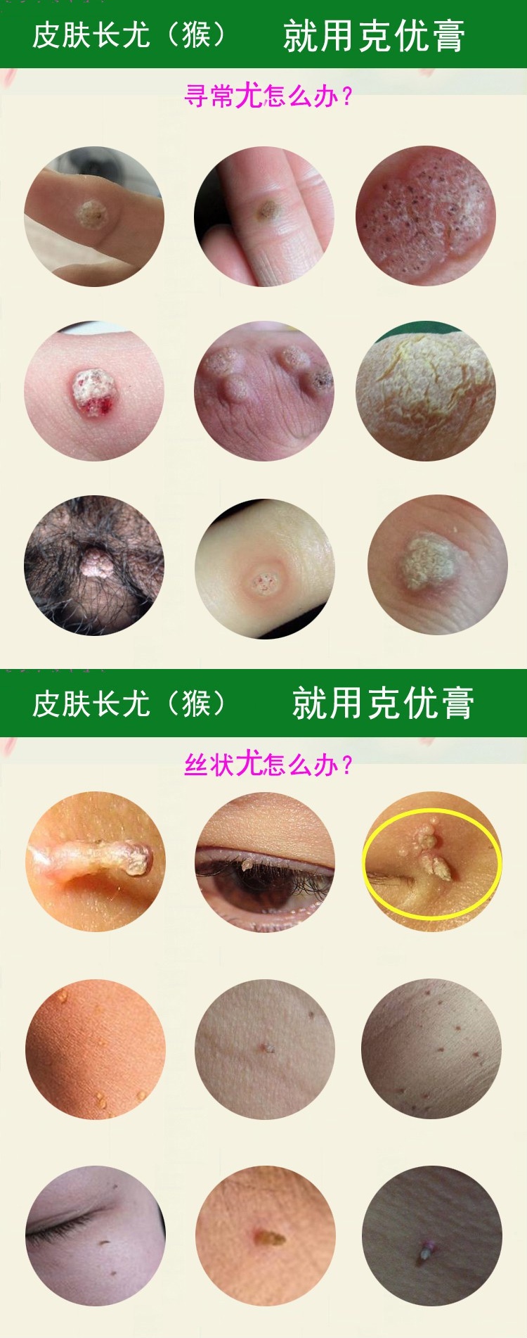 去除面部手部扁平状疣脖子丝状疣腋下肉粒皮赘子寻常疣克舒膏膏脸部去