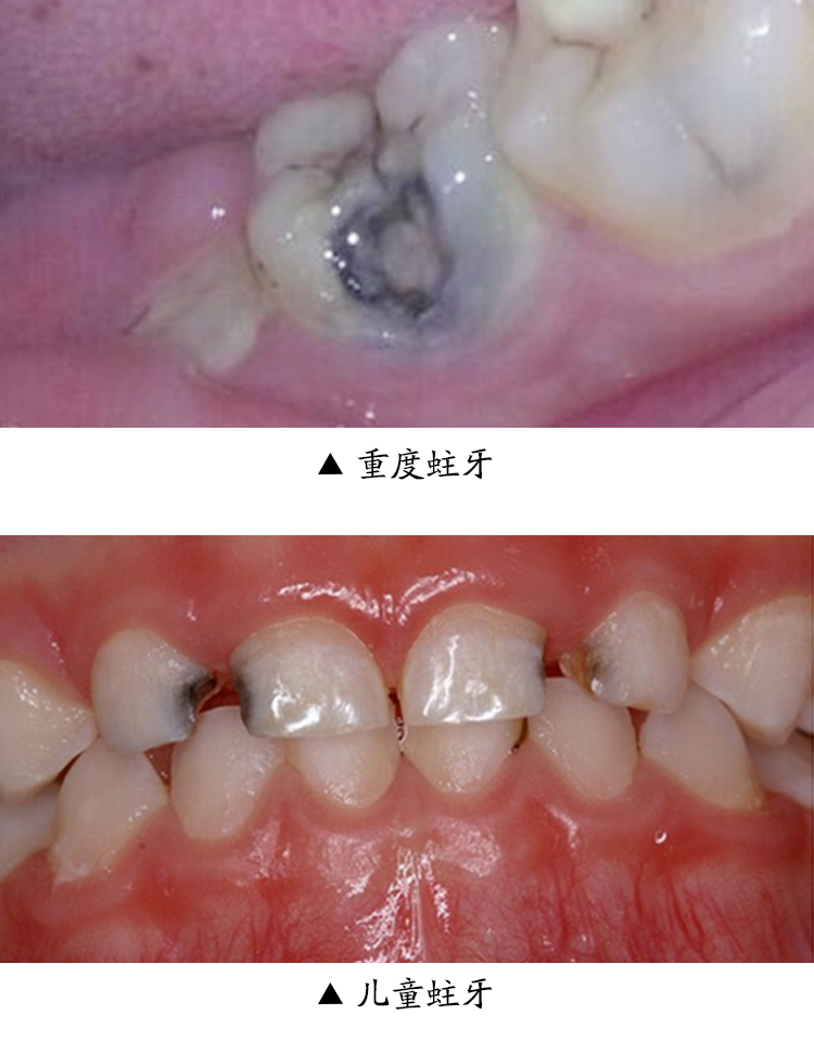 潘魅斯panmeis成人儿童牙粉非防蛀牙修复牙洞膏黑斑龋齿牙疼牙痛非