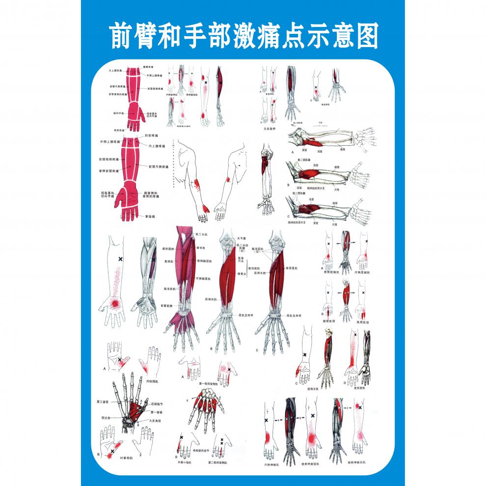 定做 激痛点肌筋膜疼痛触发点示意图解人体肌肉解剖图解墙贴装饰画40*