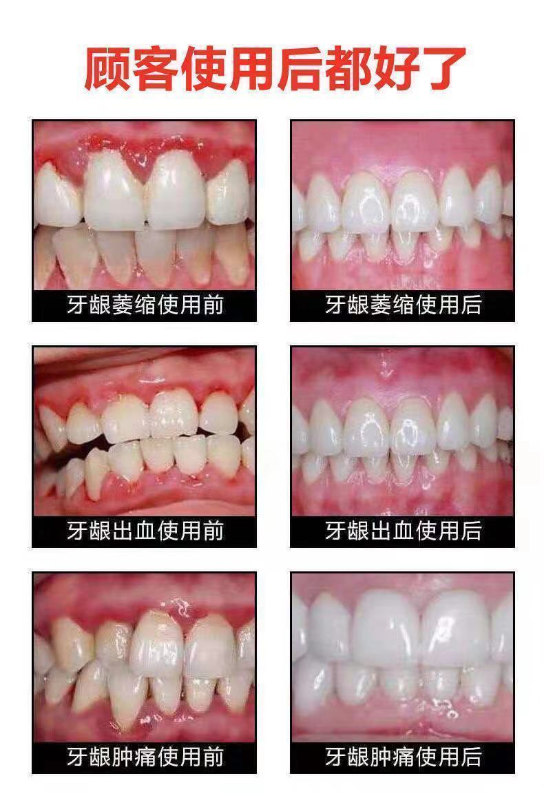 牙缝宽大当天合缝牙龈萎缩牙齿敏感牙痛出血牙齿松动固齿牙膏一支装