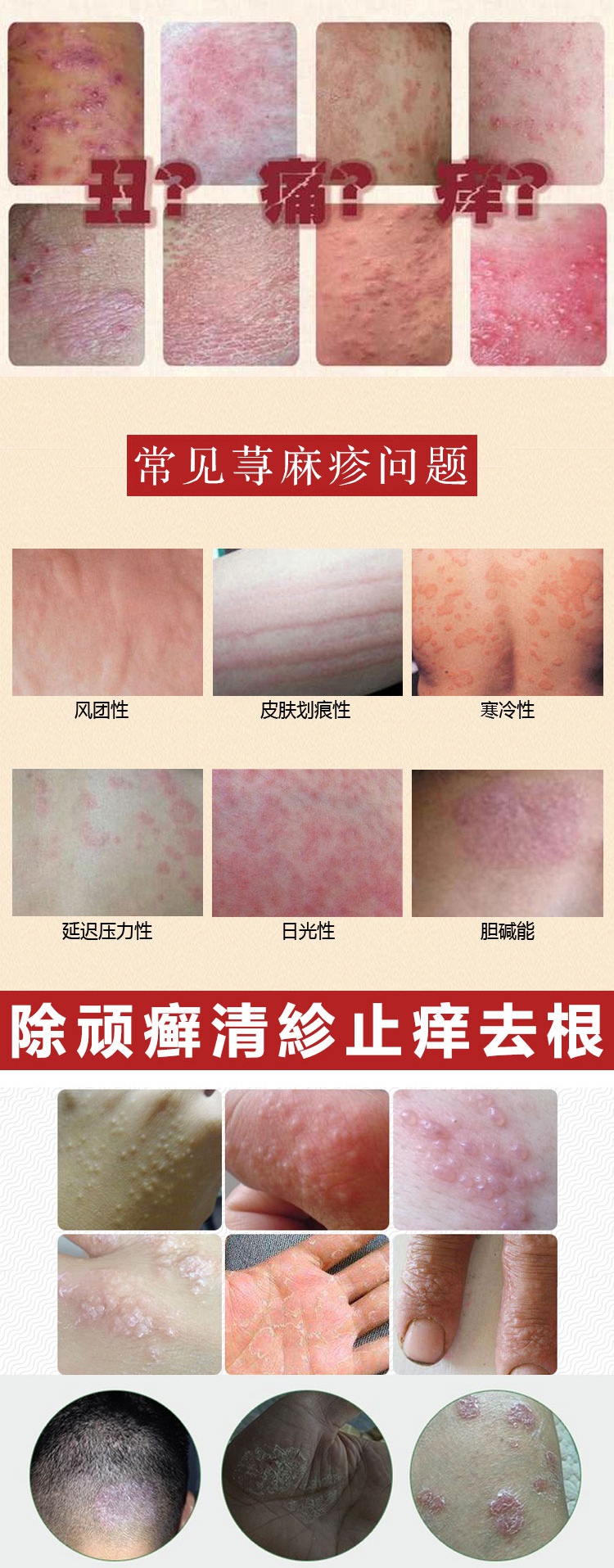 【专营】百藓夏塔热片紫椒癣酊股体藓癣止痒膏私处爱慈痒疹膏