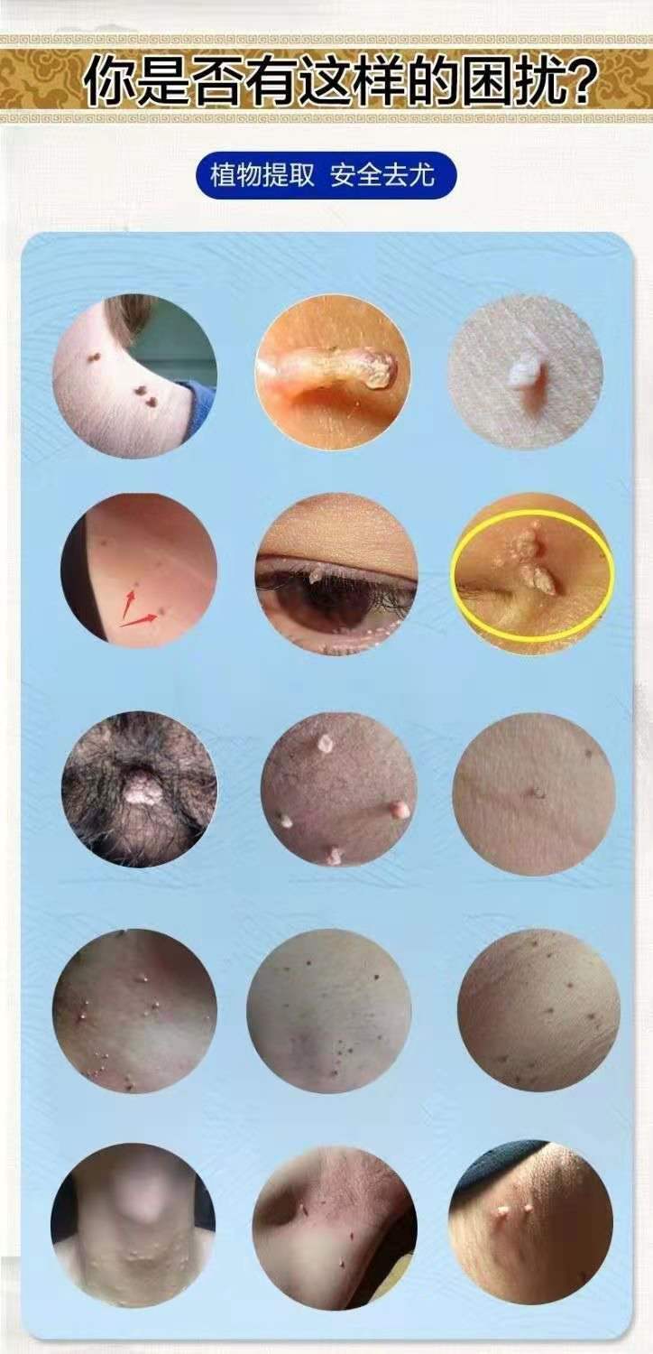 西疆域草克忧液组合装去忧尖锐湿疣丝状尤肉刺克优膏猴子强去除西疆域