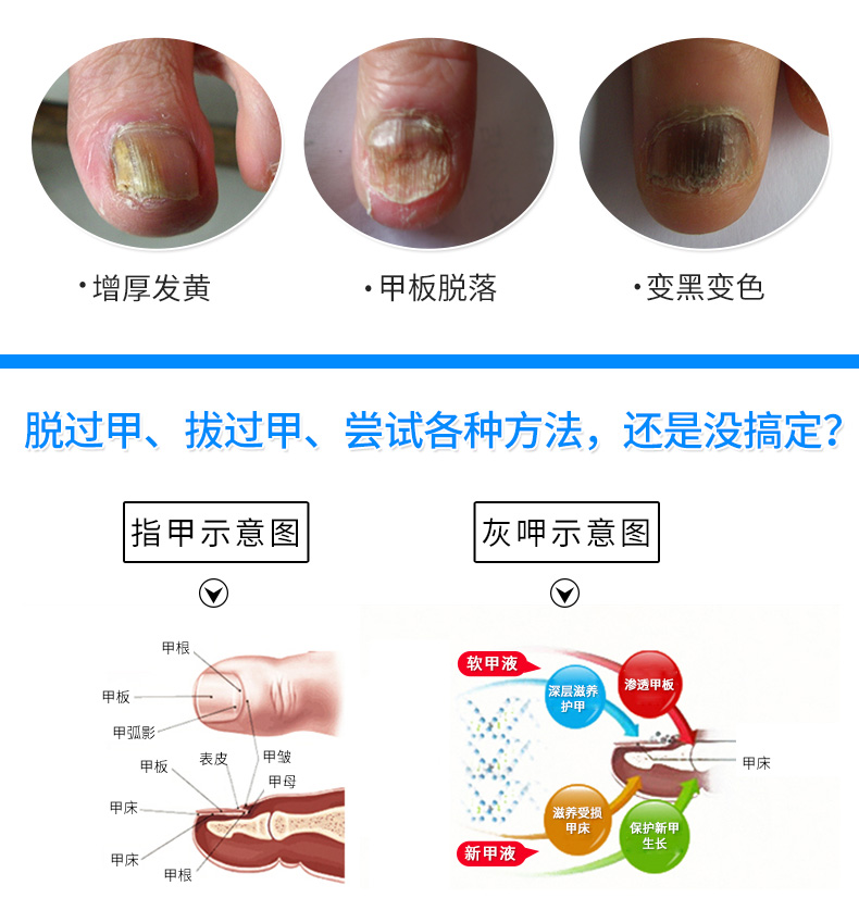 杨四郎(yang si lang)美手工具 【买二送一】灰指甲专用药 根除灰指甲