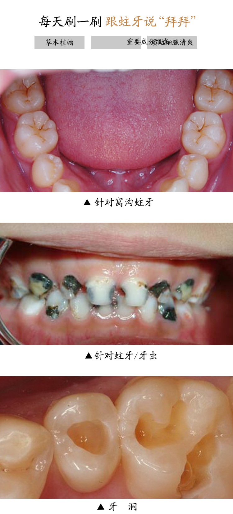 蘇寧優選兒童牙粉黑斑非蛀牙修復牙洞膏齲齒修復成人牙痛牙疼