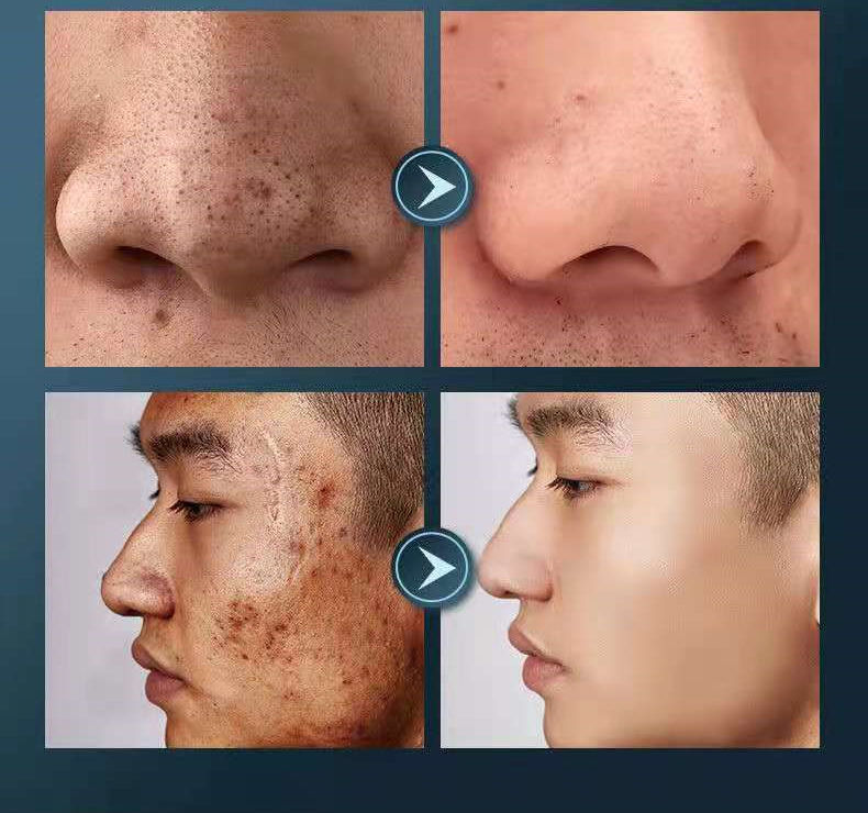 仁和竹炭吸黑头泥膜深层清洁去黑头粉刺鼻头贴全脸收缩毛孔男女士1