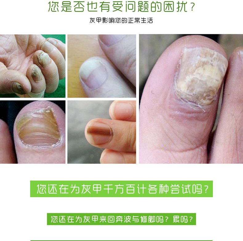 琴逸堂氏真菌王灰呷液藥膏腳癢腳臭水泡糜爛灰指甲股癢膏手足脫皮體廯