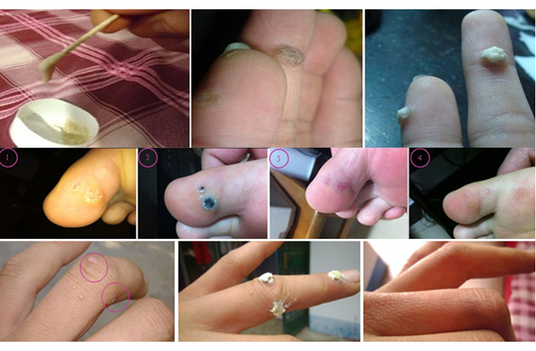 贴去除瘊子去疣灵手足部跖疣膏贴净扁平疣寻常疣肉刺瘊子甲周疣