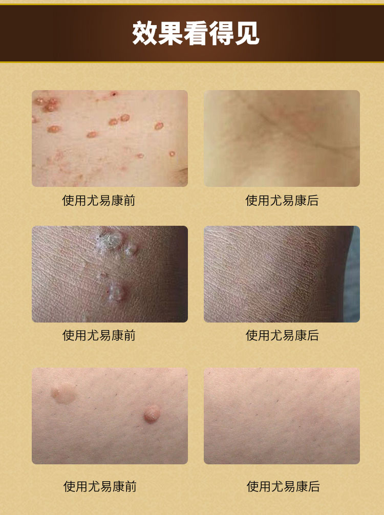 柏连喷剂男性尖锐湿庞克星 无女性尖锐湿尤易康三联除尤aa