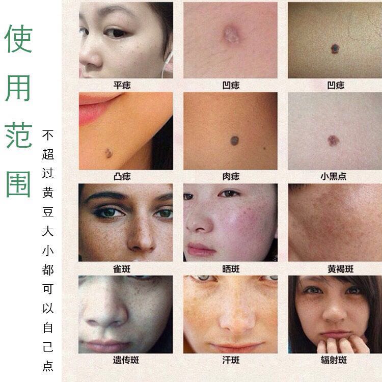 点痣药水点斑药水脸部去痣祛斑水点黑痣肉痣祛痣膏雀斑水老年斑