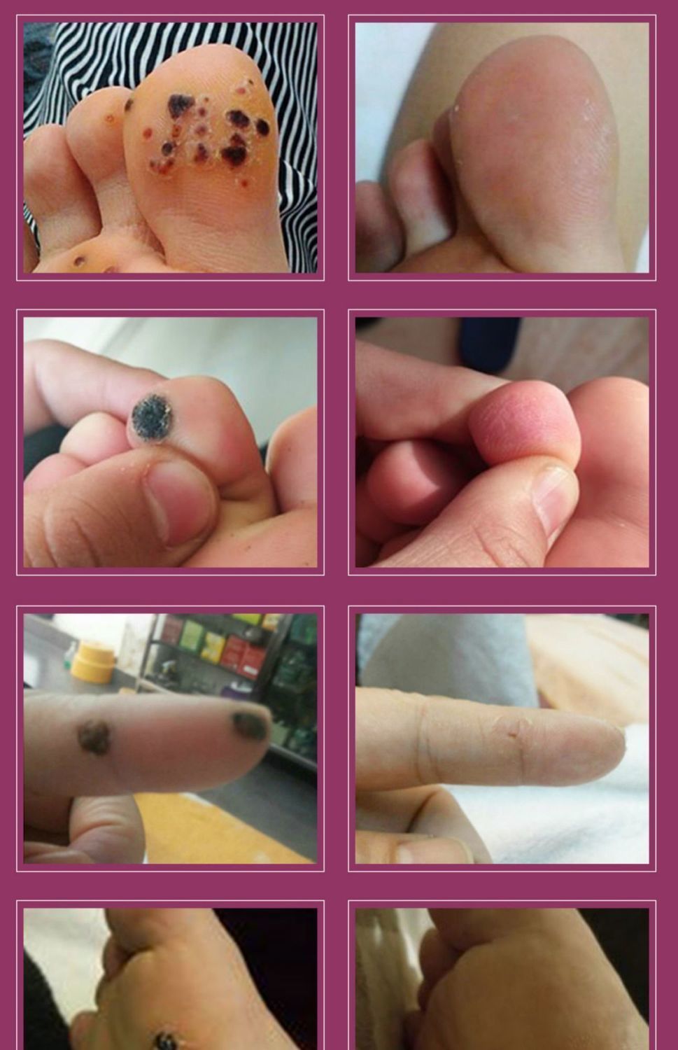 《一盒装【体验装】量少 鸡眼膏去瘊子肉粒疙瘩神器去猴子不留疤去除