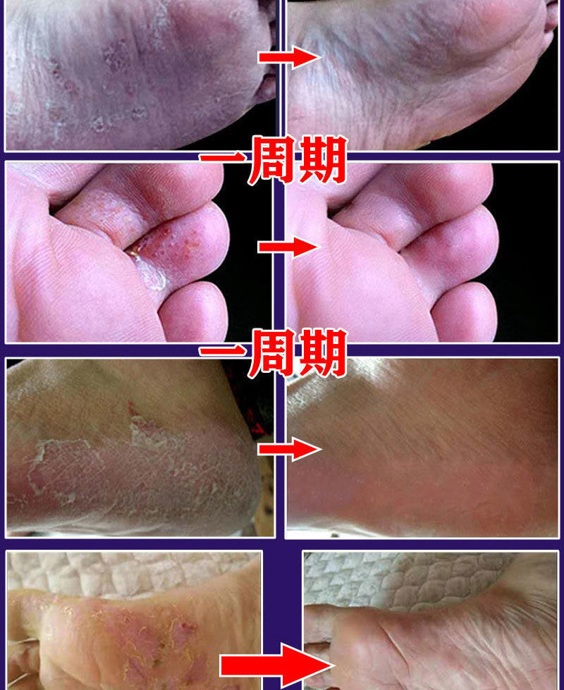 脚臭脚汗去脚气克星喷剂脚痒水泡脱皮糜烂一扫光除脚臭永久去脚臭日本