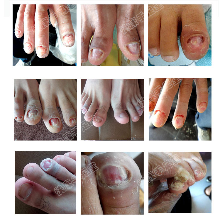 软甲膏去灰甲脱甲膏指甲软化去甲脱甲精油去除脚趾甲灰甲清灰甲净