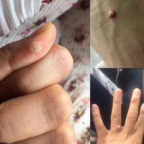 柏敦鸡尤清鸡茧跖疣老茧膏脚垫肉刺瘊子鱼鳞痣鸡眼膏甲周疣肉粒痣 发