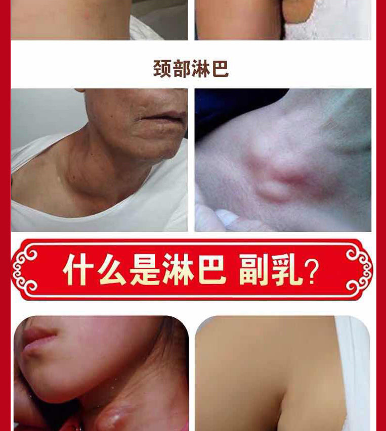 《(快準狠)副乳消貼腋下消副乳疏通排毒去淋巴結腫大副乳散結貼 不斷