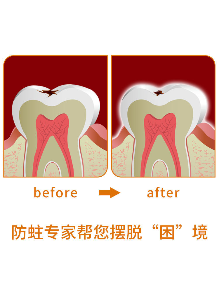 《【牙齦發炎】兒童除牙蟲牙洞牙痛立可停防蛀牙的牙膏修復齲齒黑斑