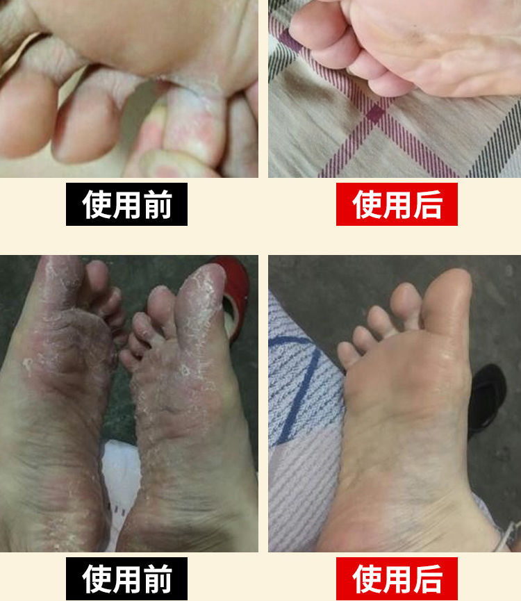 老中医秘方37天去脚气膏蚊子叮咬止痒草本白色乳膏偏方