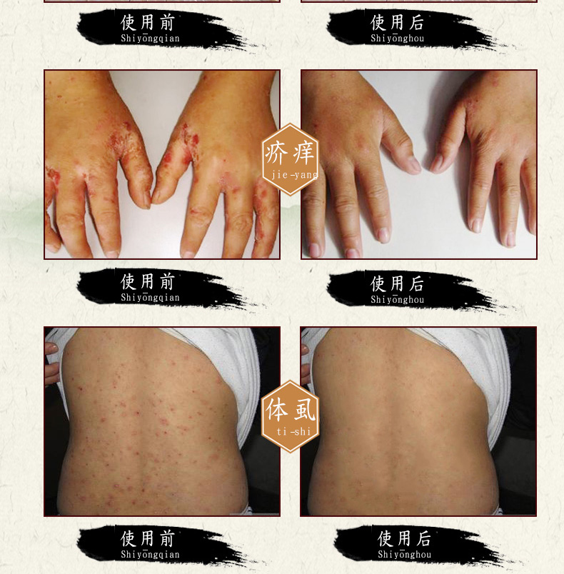 疥疮药虱疥一扫光疥癣膏芥舒宁疥疮结节疥灵霜硫磺疥得治林旦软膏疥虱