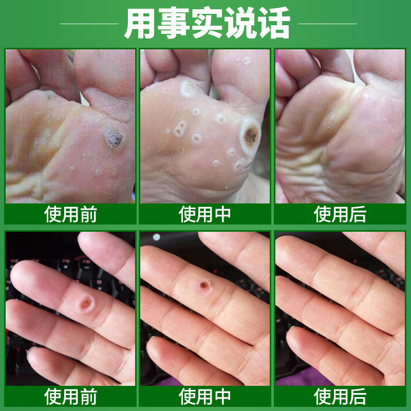 修正鸡眼贴去根鸡眼膏去除脚底死皮祛老茧趾疣手上瘊子鸡眼贴 鸡眼贴6