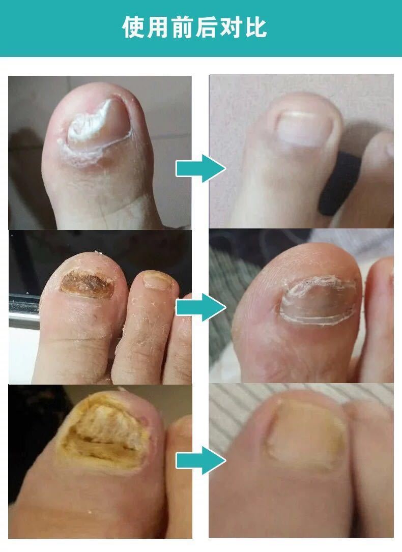 【一滴去灰甲】灰指甲特效根冶灰指甲专用液脱甲膏甲沟炎灰甲王 99%