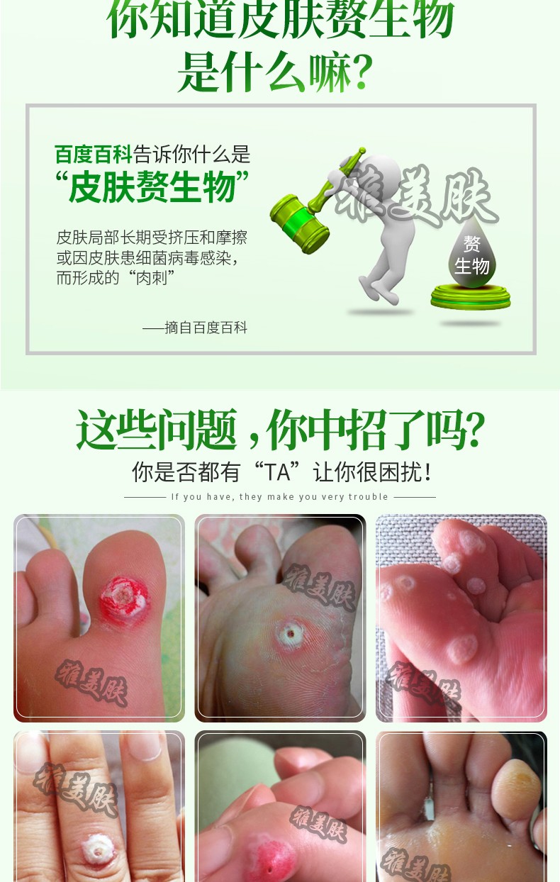 去除面部扁平眼部去除瘊子寻常疣丝状疣膏趾疣抑菌液手足部肉刺瘊药