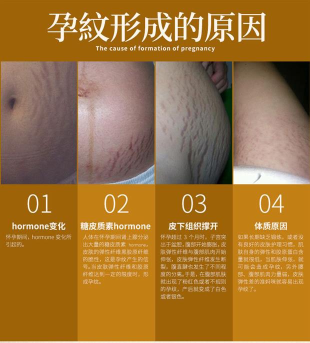 专用提拉修复霜修护霜家用孕妇阿琪思去妊娠纹按摩油肚子