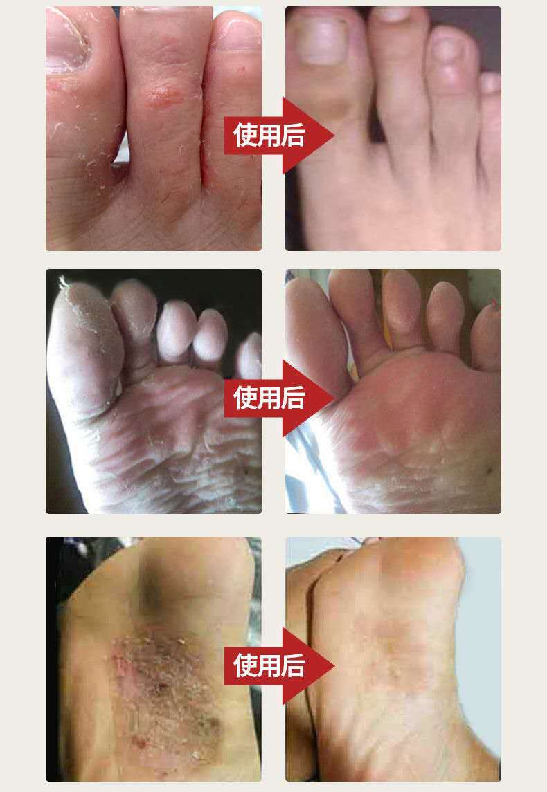 《狼毒乳膏一盒装【止痒】 狼毒脚气王脚臭脚汗去脚臭喷剂脚痒水泡