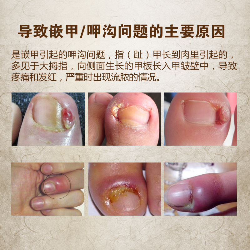 甲沟炎膜套装肉芽炎症嵌甲修甲脚趾剪刀勾专用修脚套装甲沟炎买2送1