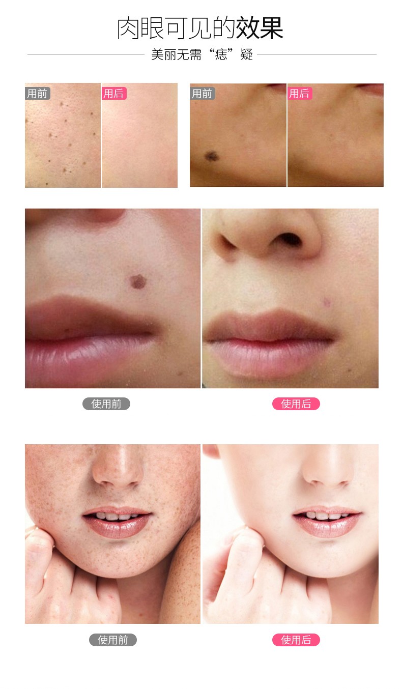 金稻点痣笔去痣仪家用脸部点除黑痣笔小白笔机洗纹身水膏仪点痣粉红色