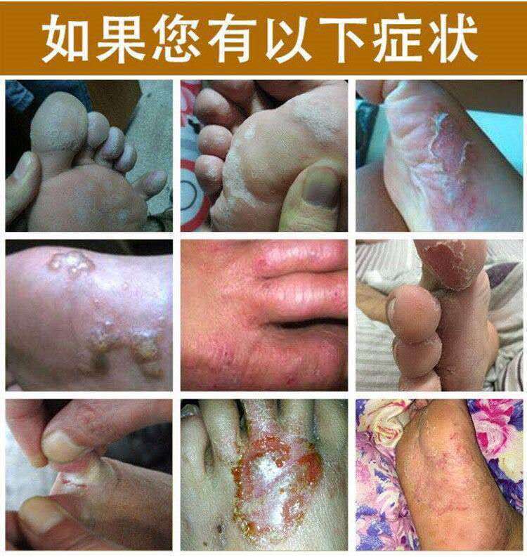 黄氏真菌王烂脚丫脚气脱皮肤瘙痒脚汗水泡灰指甲灰呷液去脚臭气膏真菌