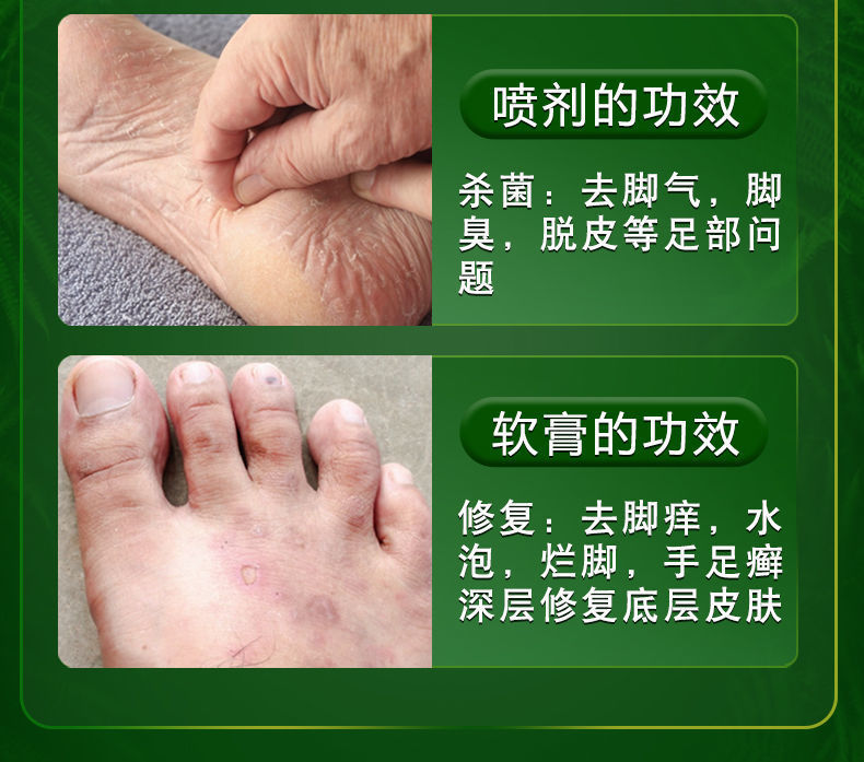 去脚气膏永不脚气王复发烂脚丫脚痒水泡糜烂脚丫干燥开裂脱皮喷剂云南