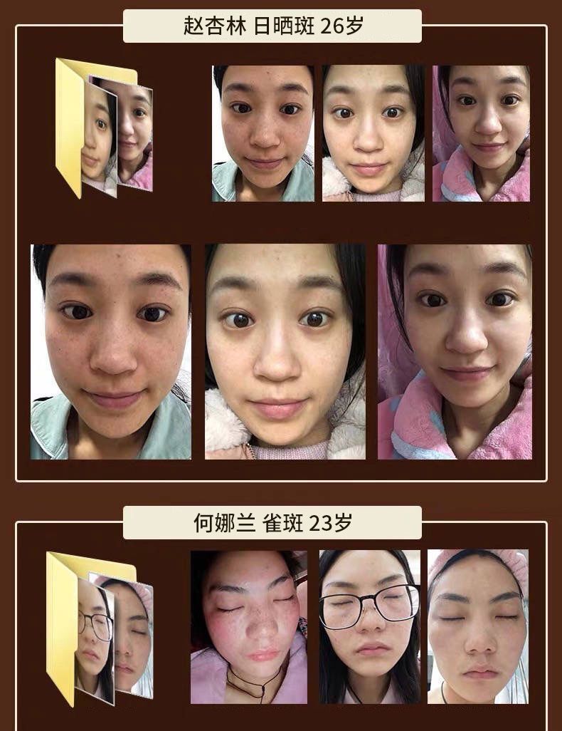 祛斑霜美白淡斑祛黑色素去斑点老年斑黄褐雀色斑草本