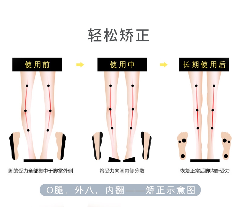 矯正鞋墊o型腿糾正外八字腳足內翻o形腿成人兒童羅圈腿型矯形神器墨斗