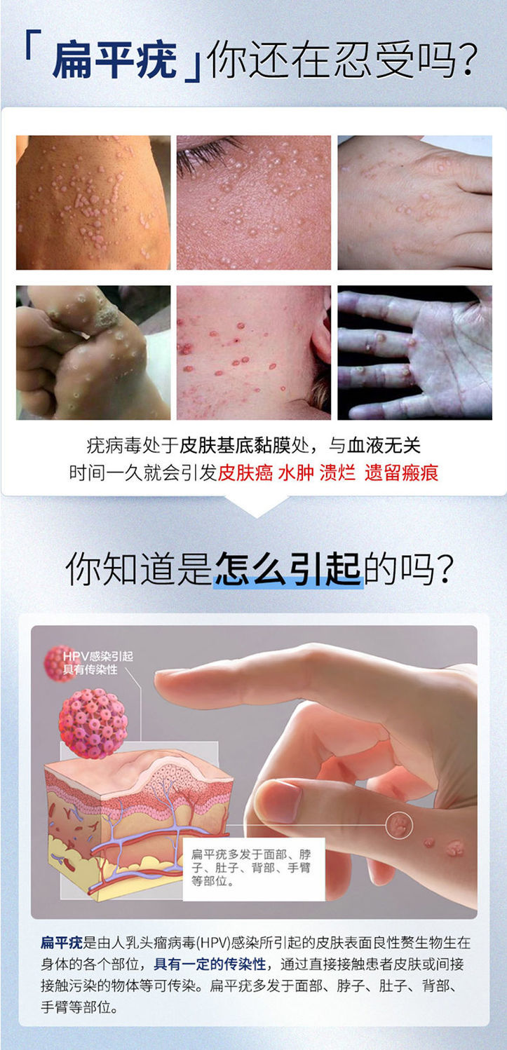 《去瘊子刺瘊猴子贴治鸡眼跖疣瘊子膏跖疣趾疣特效去除瘊子跖疣鸡眼 1盒装30ml【体验效果】》无著【摘要 书评 在线阅读】-苏宁易购图书