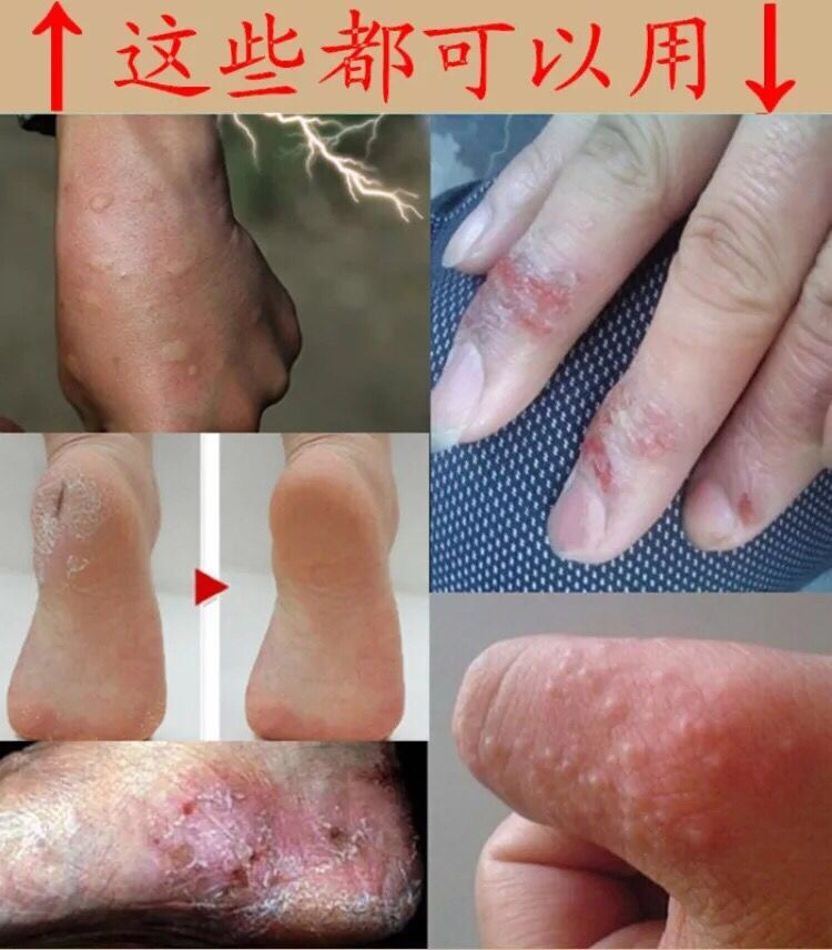 手癬膏鵝掌風手蘚膏真菌感染脫皮水泡成人止癢手足皮膚病水泡型足癬藥