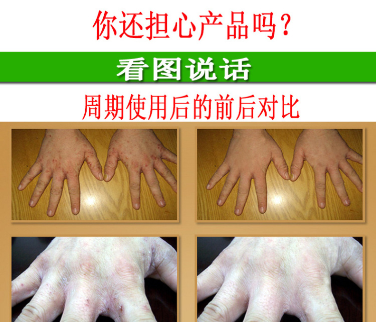 伊白云飞须泡/膏/啫喱 疥疮膏去疥虫疥螨一扫光疥舒疥止痒膏身体止痒