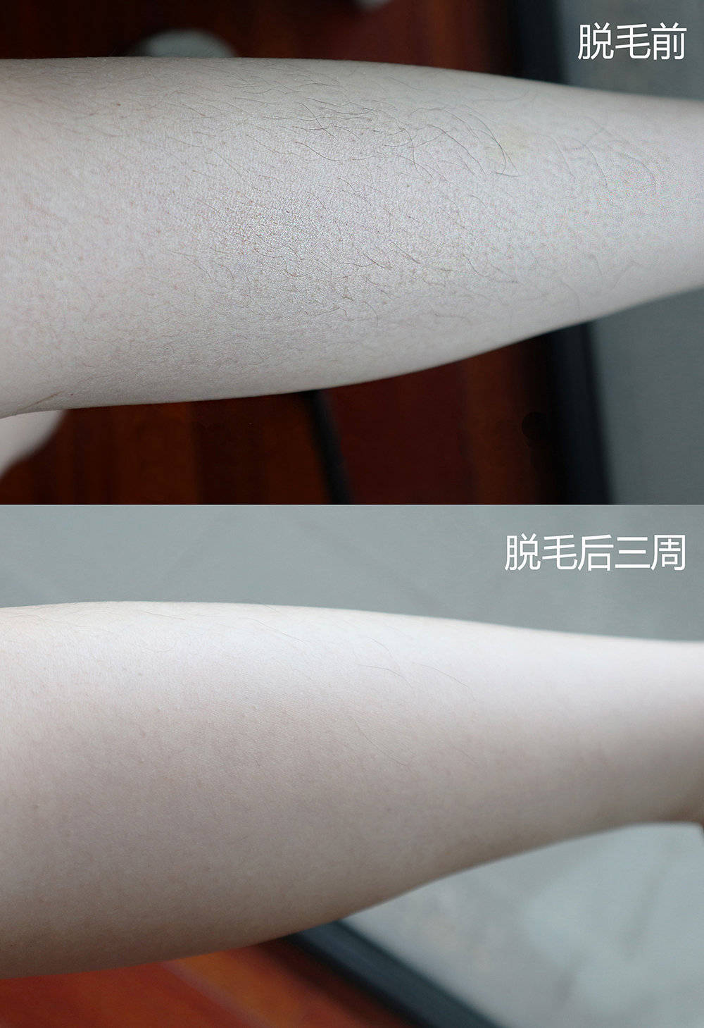 smoothskin慕金bare英国激光脱毛仪家用冰点光子全身脱毛