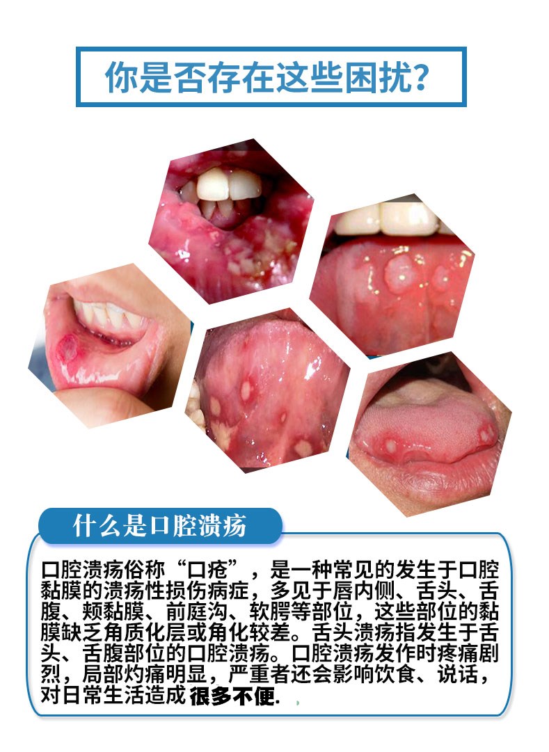 口腔溃疡喷剂复发性口疮凝胶喷雾口舌生疮非一点灵膏贴