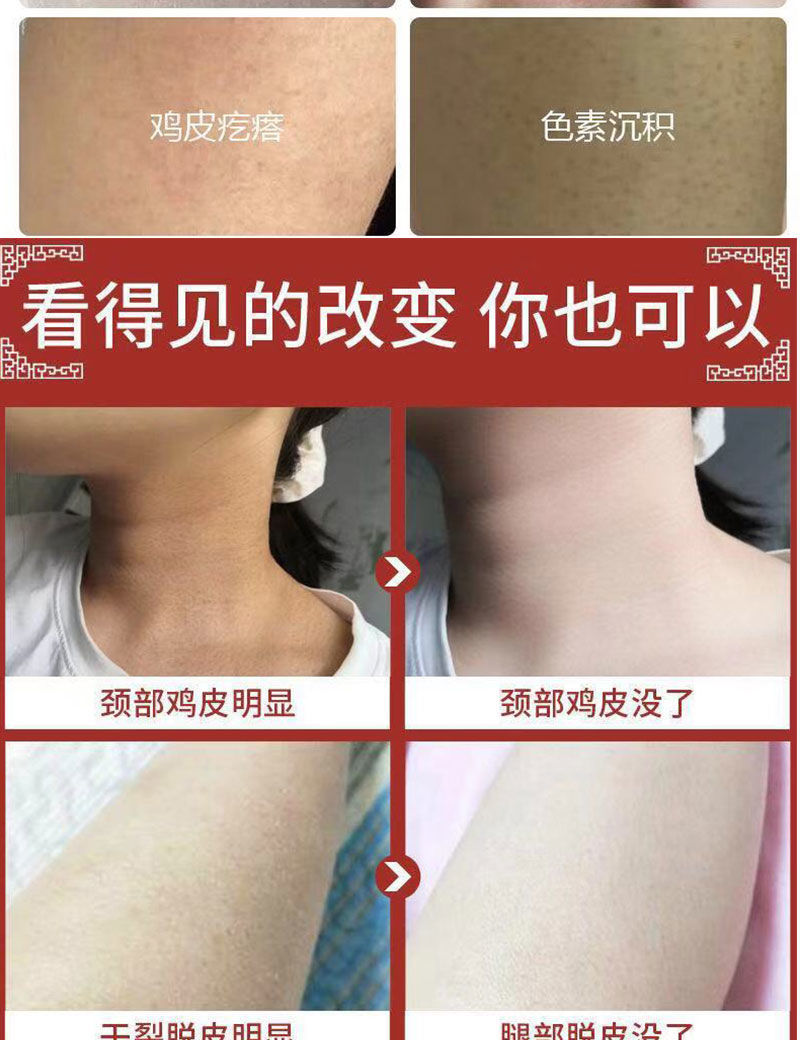 身上都是红色鸡皮疙瘩很痒(身上长红色鸡皮疙瘩还痒是什么原因)