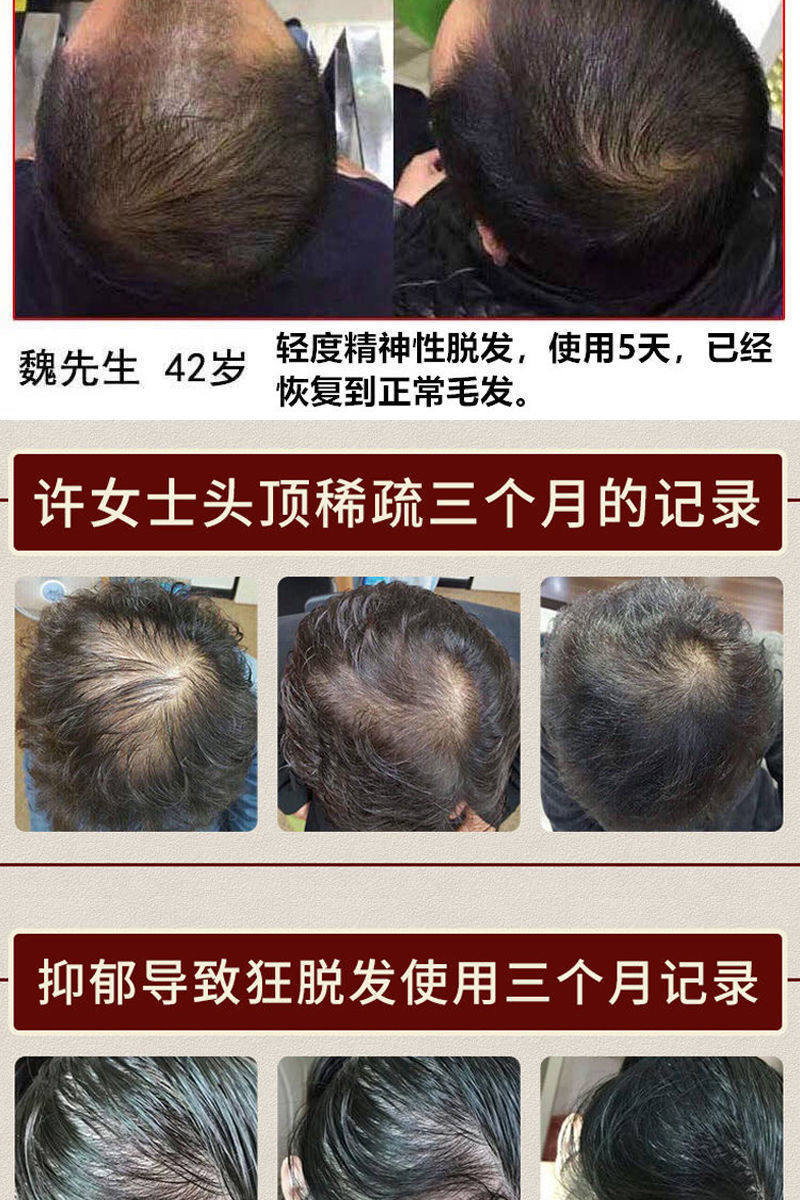 101%全愈 ]育发生发剂增发密发育发液快速长头发神器 单品 严重脱发