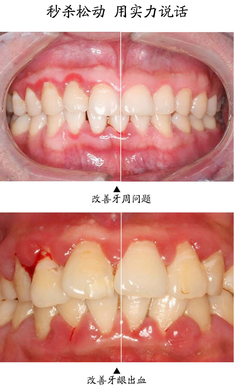 正常牙龈图片对比图片