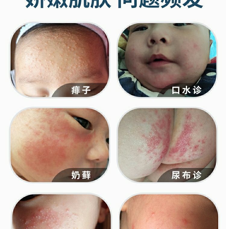 湿疹止痒外用宝宝婴宝干性湿疹霜婴幼儿红屁屁奶藓膏新生儿无激素湿疹