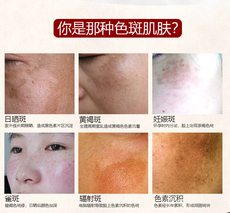 柏诗春天八倍白祛斑霜五件套补水保湿祛斑淡斑套装