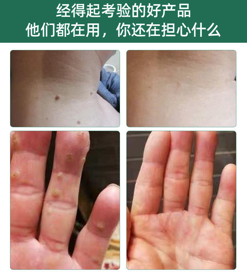 《去除脖子上小肉粒颈部腋下瘊子疙瘩赘克疣液无痛温和不留疤拒 优肤