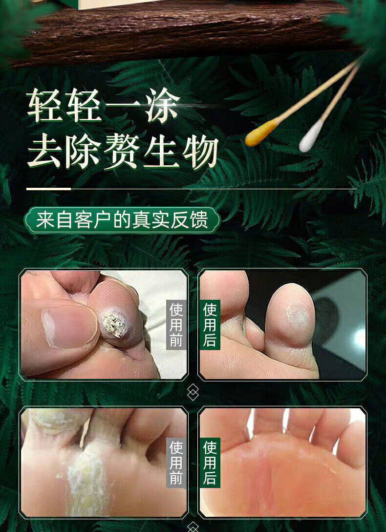 修正清茧灵脚茧消茧灵厚皮脚底老茧手茧祛去除茧子神器软化剂脚垫清茧