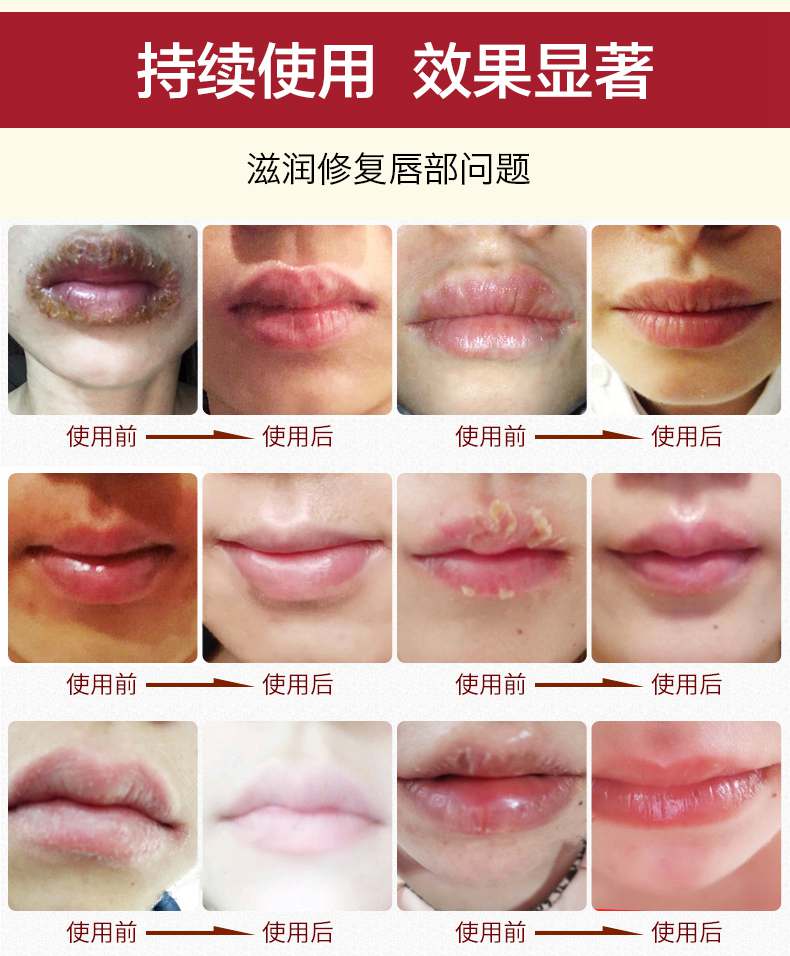 口唇炎嘴唇修复防干裂脱皮上火起小水泡痒烂嘴角唇部嘴巴子润唇膏