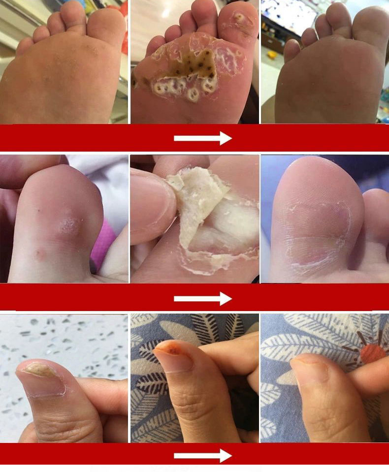 瘊疣偏方去身体各部瘊子小肉粒疙瘩手足鸡眼硬厚老茧刺猴子专用膏》无