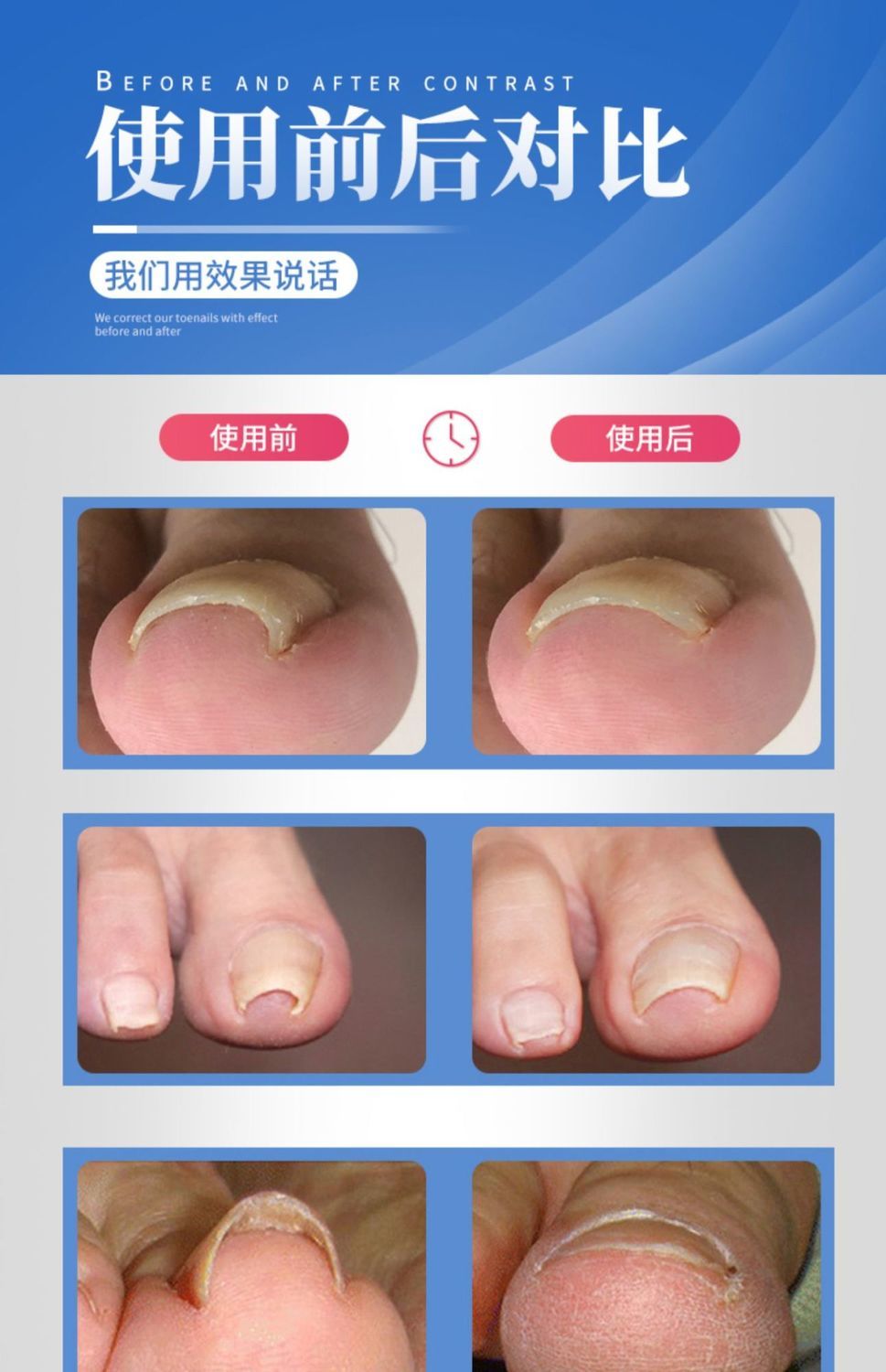 《正甲扣甲沟炎矫正器贴片指甲矫正器嵌甲专用脚趾甲往肉里长神器