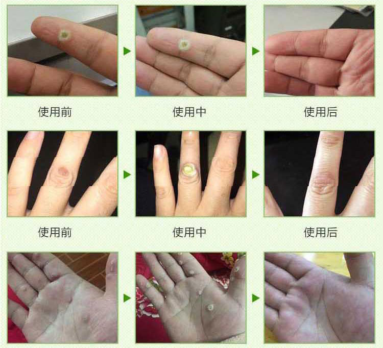 去除脚底跖疣膏特效治病毒拓疣砣祛手足部寻常疣趾疣瘊子灵刺猴子瘦腿