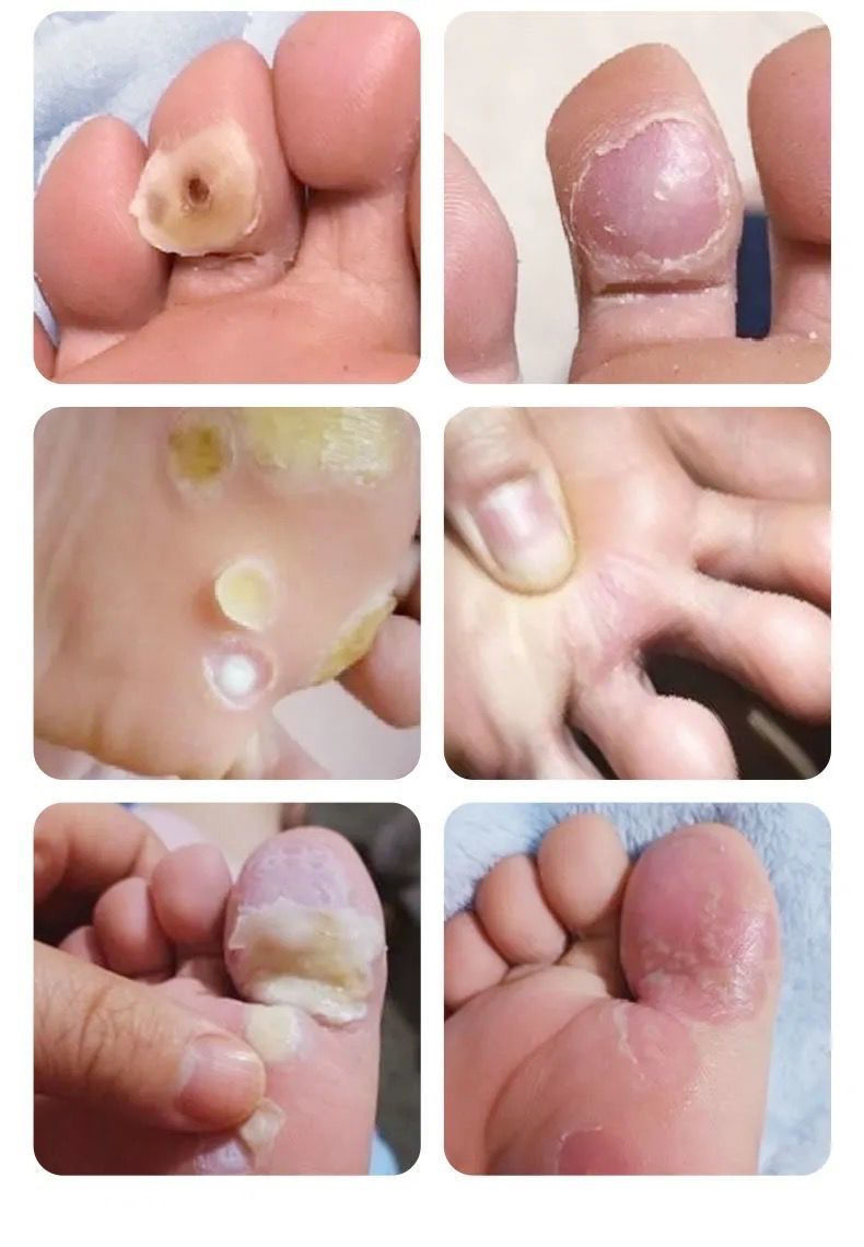 《鸡眼贴膏去除手足脚趾脚底脚上鸡眼瘊子老茧肉刺特效除死皮专用
