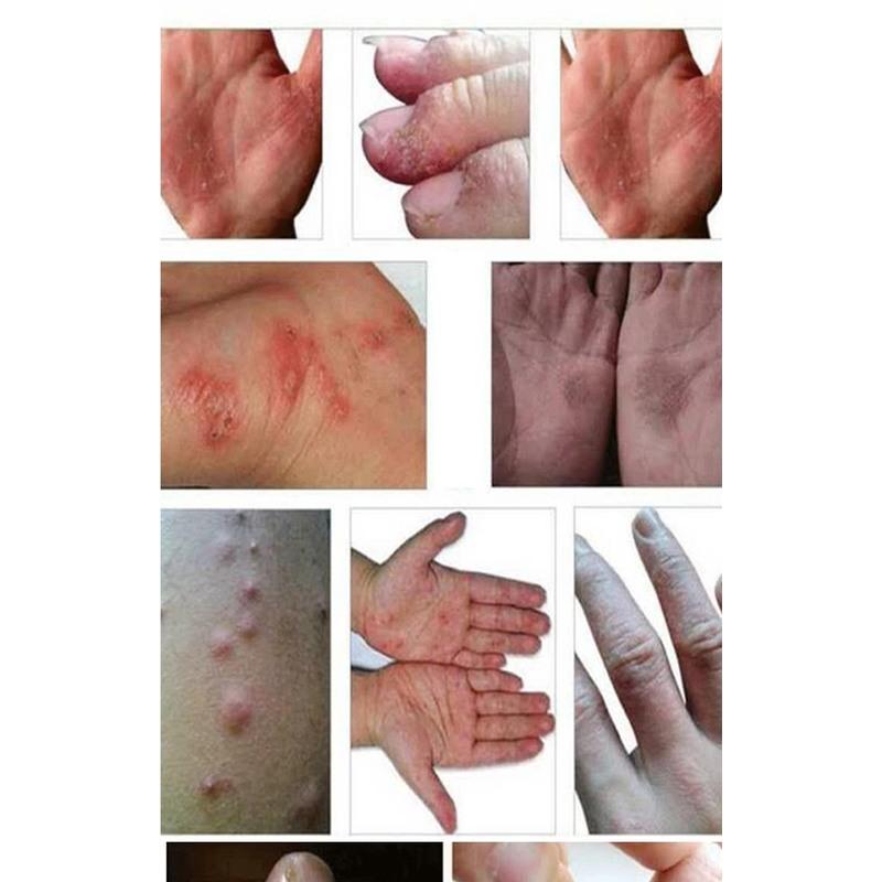 体癣与湿疹的区别图图片